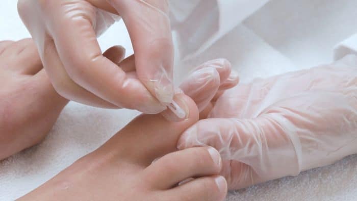 Nagelspangen Behandlung in der Podologischen Praxis Kovac in Gelsenkirchen-Buer